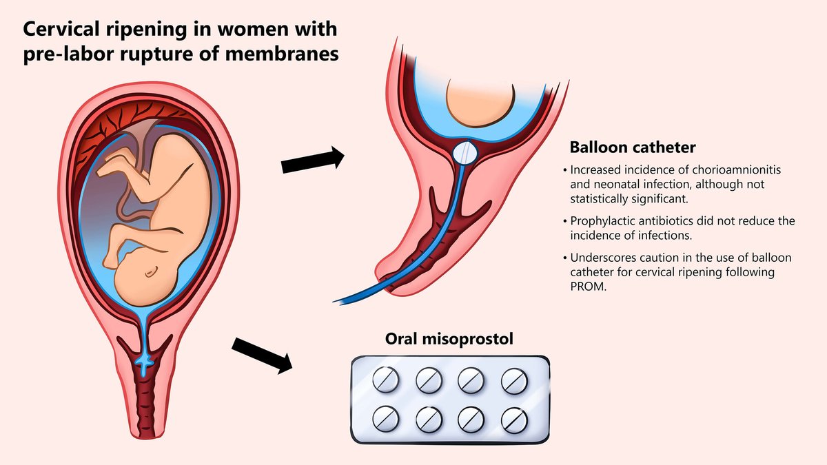 Our findings indicate a trend towards higher rates of chorioamnionitis and neonatal infections with balloon catheter use compared to oral misoprostol use for induction of labor following pre-labor rupture of membranes.
doi.org/10.1111/aogs.1…
