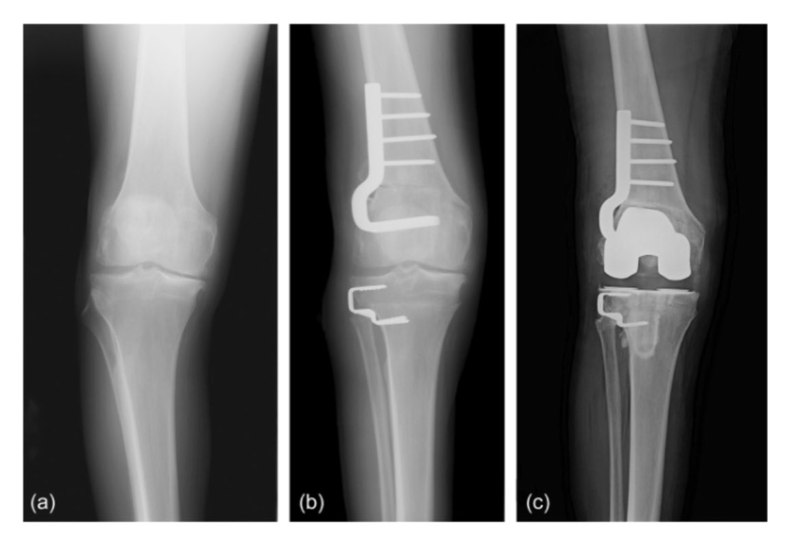 Check out the latest in our #Osteotomy series!

Satisfactory outcomes and uncompromised subsequent total knee arthroplasty function at mean 26 years (!!!) follow-up after double level osteotomy.

pubmed.ncbi.nlm.nih.gov/39781369/