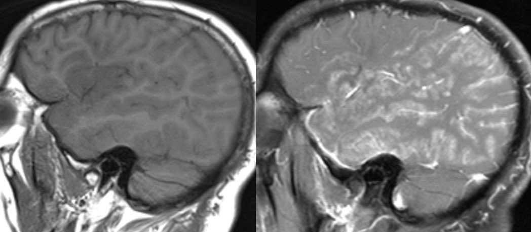 Daniel Gewolb, MD (@daniel_gewolb) on Twitter photo 40 y/o M presents w/ seizures and severe headache. Patient has a hx of right frontal WHO grade 2 astrocytoma s/p resection and radiotherapy completed 8 years prior. What is the most likely diagnosis? 🧠
#medicine #neurosurgery #neurology #radres #futureradres <a href="/AlbanyMedRadRes/">Albany Med Radiology Residency</a> 40 y/o M presents w/ seizures and severe headache. Patient has a hx of right frontal WHO grade 2 astrocytoma s/p resection and radiotherapy completed 8 years prior. What is the most likely diagnosis? 🧠
#medicine #neurosurgery #neurology #radres #futureradres <a href="/AlbanyMedRadRes/">Albany Med Radiology Residency</a>
