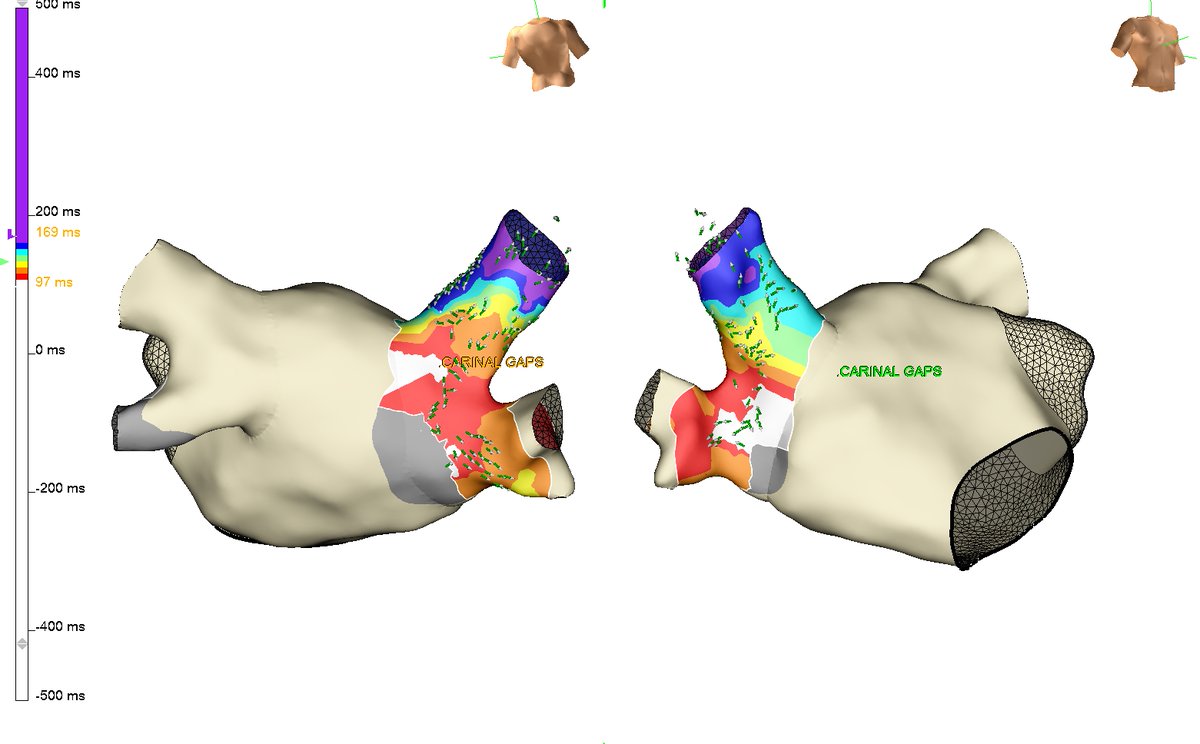 DrEdoSanhueza's tweet photo. At the last PVI, we didn't get first past isolation on the right side, but the HD Grid® showed its precision in identifying the Gaps and resolving the problem quickly.
Thanks, Dr. Sanoj Chacko, David Bakker, Prince Joseph and @JacobPardy, for all your support and help #NoGap https://t.co/4acuQOVdni