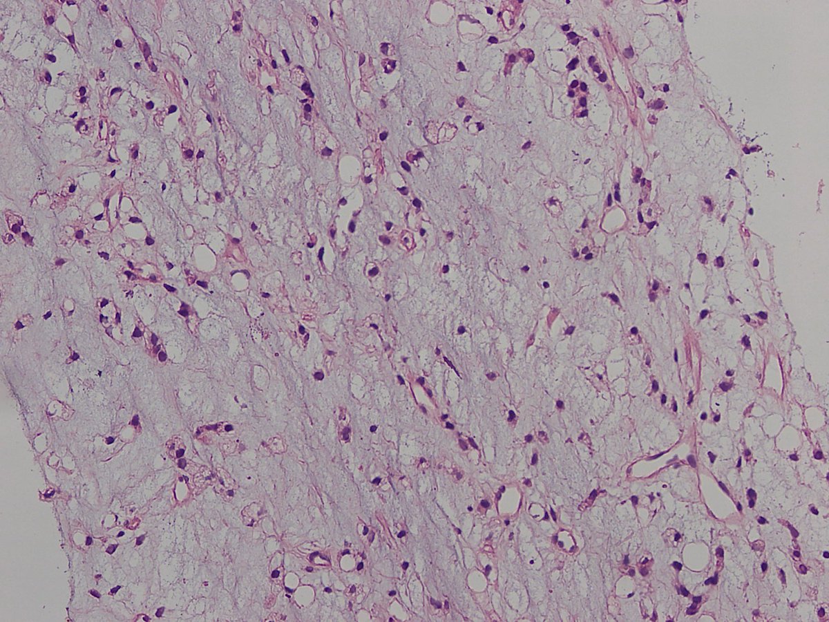 A 45 year old male , thigh mass. 
Classic case of Myxoid liposarcoma. #PathX #BSTpath #softtissuetumors