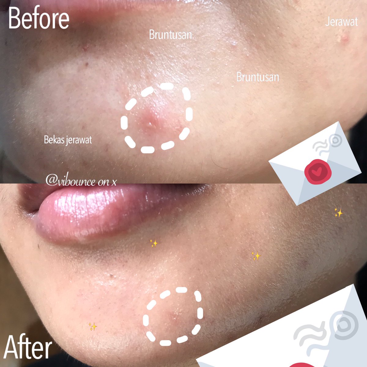 Seneng banget bisa bebas dari bruntusan-jerawat-bekas jerawat 🥳🥳

Semoga tahun ini kita semua bisa tetap glowing dengan cara yg gampang 🫶🏻