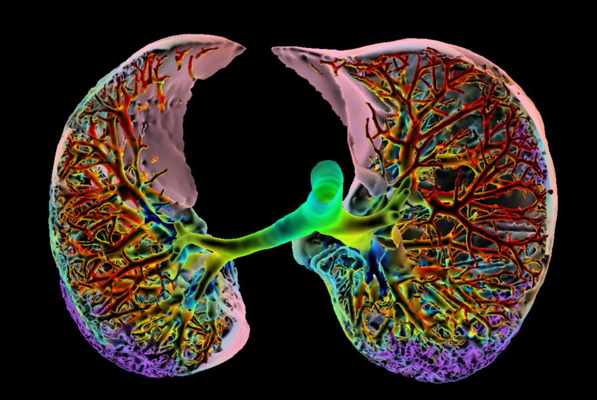 The Lancet Rheumatology (@thelancetrheum) on Twitter photo Tumour necrosis factor inhibitor safety in rheumatoid arthritis-associated interstitial lung disease
Linked Comment by Gregory C McDermott & <a href="/jeffsparks/">Jeffrey Sparks MD MMSc</a> thelancet.com/journals/lanrh… Tumour necrosis factor inhibitor safety in rheumatoid arthritis-associated interstitial lung disease
Linked Comment by Gregory C McDermott & <a href="/jeffsparks/">Jeffrey Sparks MD MMSc</a> thelancet.com/journals/lanrh…