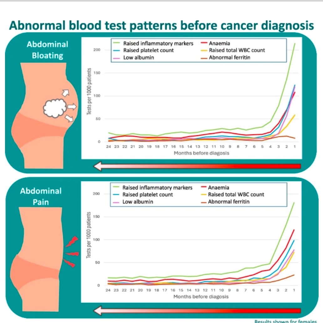 Dr Meena Rafiq (@drmeenarafiq) on Twitter photo 🩸 🩸Common blood test abnormalities are early signals of cancer 🦠 in some individuals with non-specific abdominal symptoms and could support expedited cancer diagnosis. Read my new paper in <a href="/BrJCancer/">British Journal of Cancer</a> here: nature.com/articles/s4141…
<a href="/garyabel/">Gary Abel</a> <a href="/GLyratzopoulos/">YoryosLyratzopoulos</a> <a href="/BexKWhite/">Becky White</a> <a href="/UCL_BSH/">Behavioural Science & Health UCL</a> 🩸 🩸Common blood test abnormalities are early signals of cancer 🦠 in some individuals with non-specific abdominal symptoms and could support expedited cancer diagnosis. Read my new paper in <a href="/BrJCancer/">British Journal of Cancer</a> here: nature.com/articles/s4141…
<a href="/garyabel/">Gary Abel</a> <a href="/GLyratzopoulos/">YoryosLyratzopoulos</a> <a href="/BexKWhite/">Becky White</a> <a href="/UCL_BSH/">Behavioural Science & Health UCL</a>