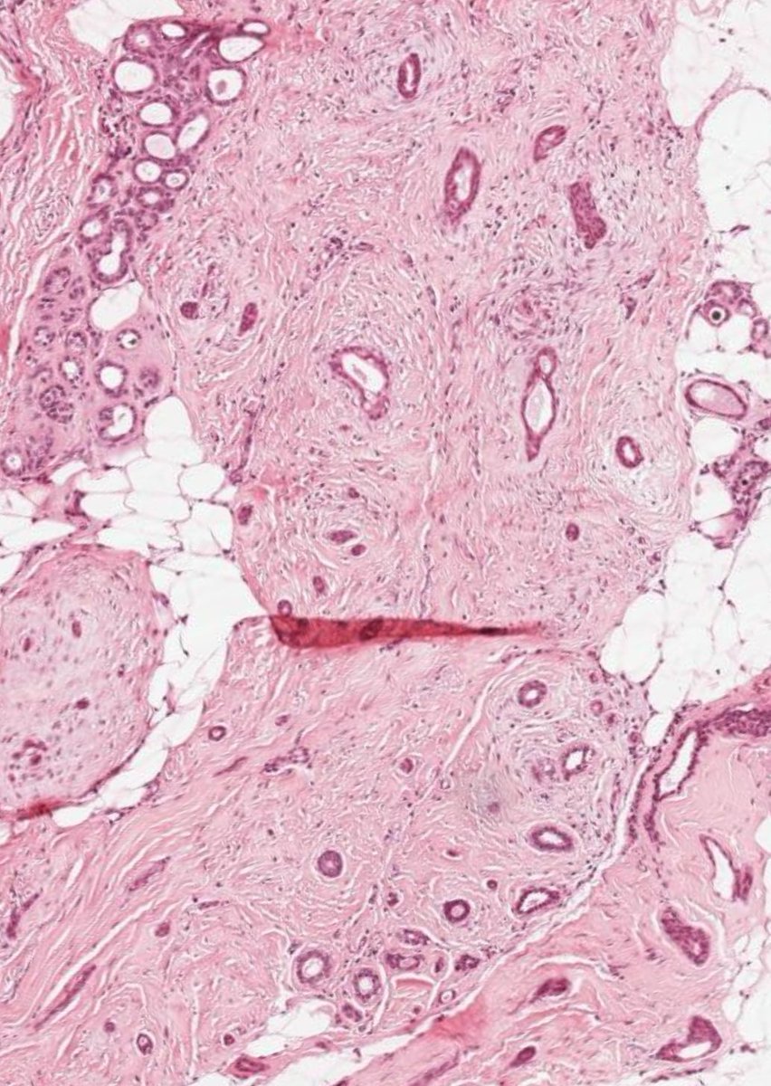 NeelamBeee's tweet photo. 45-year-old female, palpable subareolar mass under your microscope🔬👀 Diagnosis?

A) Nipple adenoma
B) Syringomatous tumor of nipple 
C) Tubular carcinoma
D) Low-grade adenosquamous carcinoma

#PathTwitter #BreastPath #PathResidents #TheBeautyThatIsPath #NippleLesions https://t.co/isbVvjlUsv