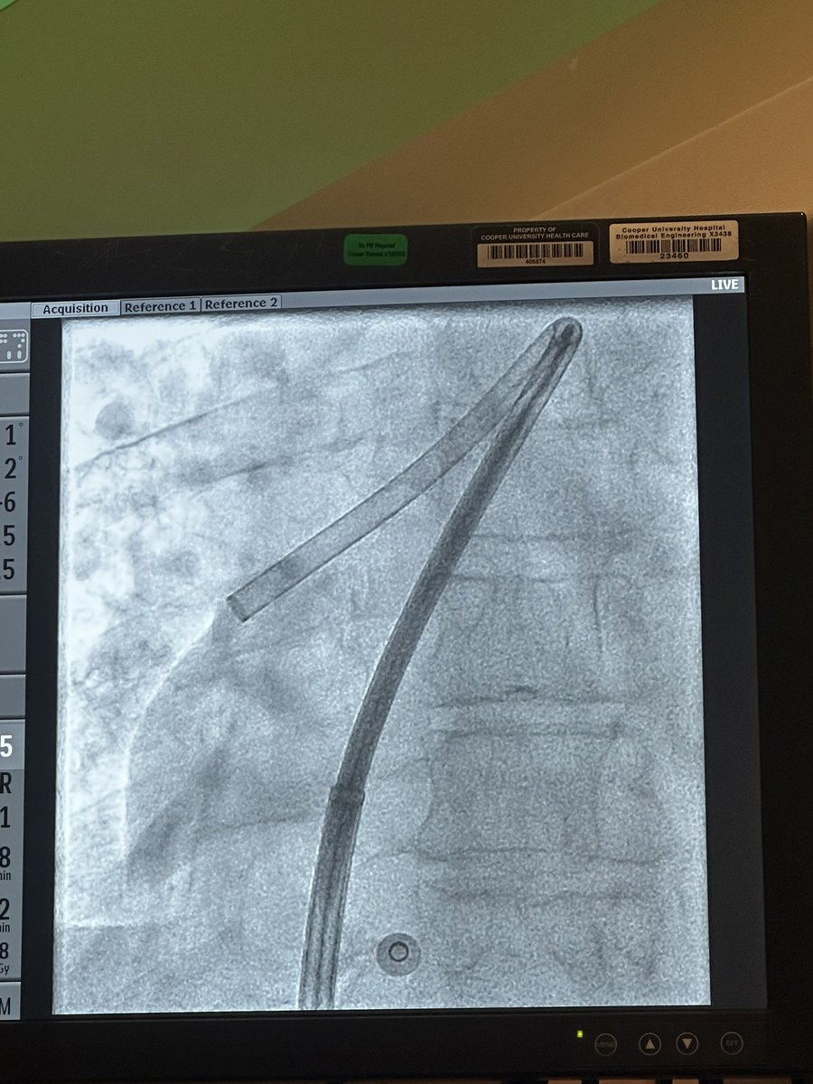 ic_cooper's tweet photo. Outstanding High risk Pulmonary Embolism case with Penumbra Flash and their new Hemolock sheath! Completed case in 18 minutes and patient did amazing! #PERT #hemolock #element #clotbusters https://t.co/wDxtDpHNJa