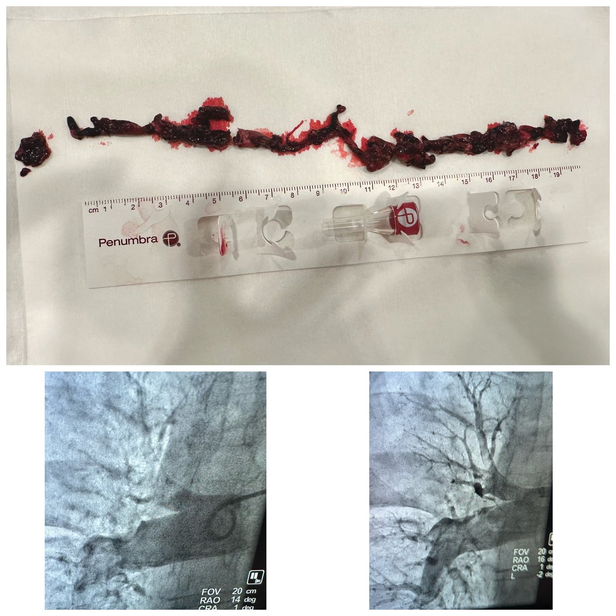 ic_cooper's tweet photo. Outstanding High risk Pulmonary Embolism case with Penumbra Flash and their new Hemolock sheath! Completed case in 18 minutes and patient did amazing! #PERT #hemolock #element #clotbusters https://t.co/wDxtDpHNJa