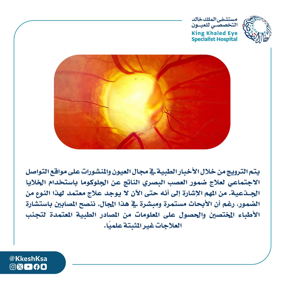 KKESHKSA's tweet photo. نود التنويه بخصوص مايتم تداوله في وسائل التواصل الاجتماعي عن علاج لضمور العصب البصري الناتج عن الجلوكوما باستخدام الخلايا الجذعية بأنه لا يوجد علاج لهذا الضمور حتى الآن..

ونتمنى من الجميع أخذ المعلومات من الجهات الطبية المعتمدة بالسعودية.

#أنتم_بالعيون https://t.co/xhKgbTQaXd