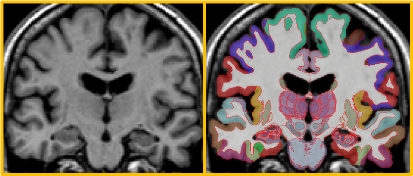 Juan Eugenio Iglesias (@juaneugenioigl1) on Twitter photo Major update to NextBrain segmentation! Version 1 was unusable without a huge GPU. New release:
1. Uses <a href="/rohitrango/">Rohit</a>'s FireANTs & simplified atlas to segment a brain in 20-30 mins without a GPU (or minutes on a GPU).
2. It is more robust.
Give it a try!
surfer.nmr.mgh.harvard.edu/fswiki/HistoAt⦠Major update to NextBrain segmentation! Version 1 was unusable without a huge GPU. New release:
1. Uses <a href="/rohitrango/">Rohit</a>'s FireANTs & simplified atlas to segment a brain in 20-30 mins without a GPU (or minutes on a GPU).
2. It is more robust.
Give it a try!
surfer.nmr.mgh.harvard.edu/fswiki/HistoAtā¦
