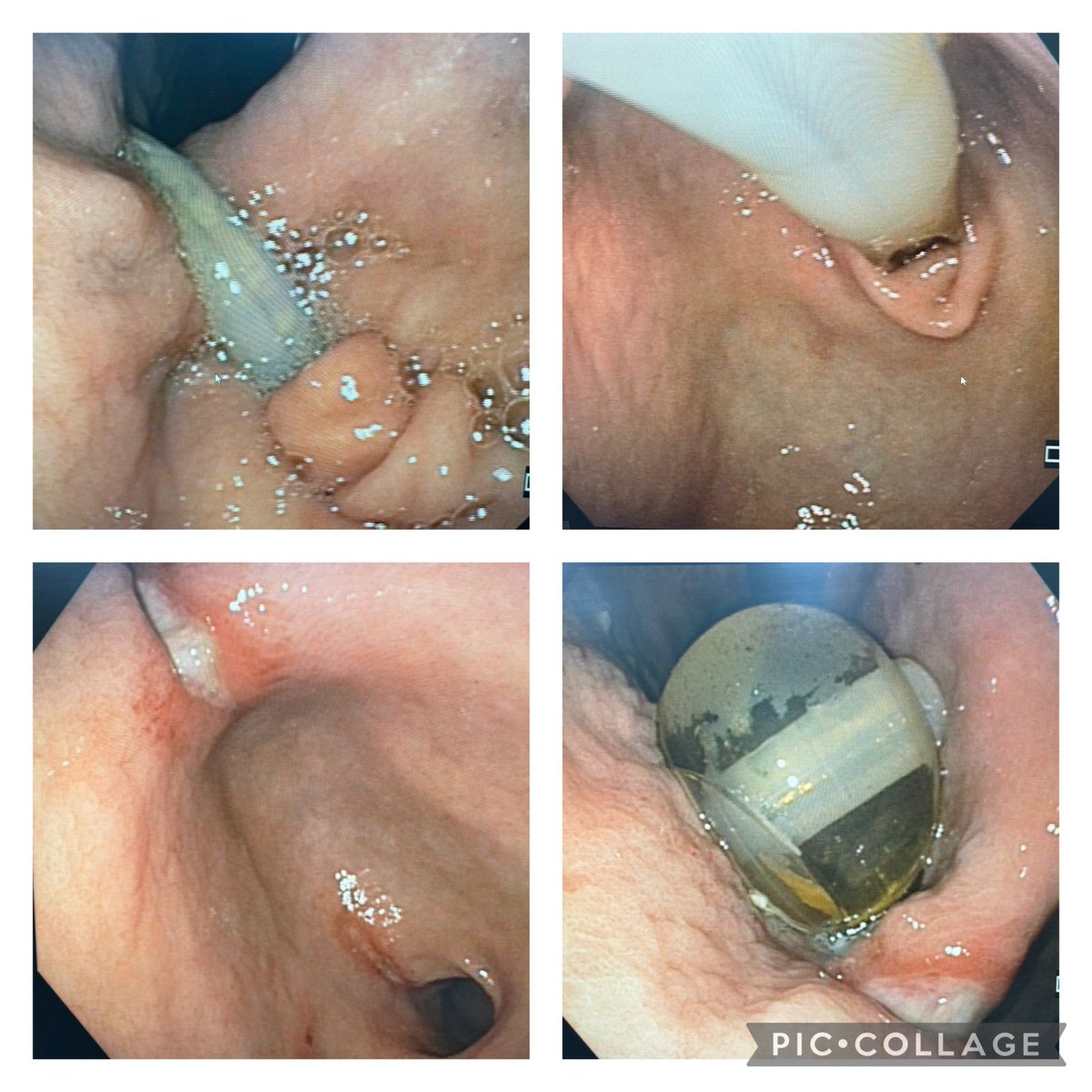 Migration of a replacenebt PEG with an inflatable baloon. Patient came with vomiting and leakage of feeds. Balloon has migrated into D1. Pressure ulcers at the lesser curvature and pylorus from tube. Tube pulled and placed with a snug washer at 2cm. 
#MedTwitter