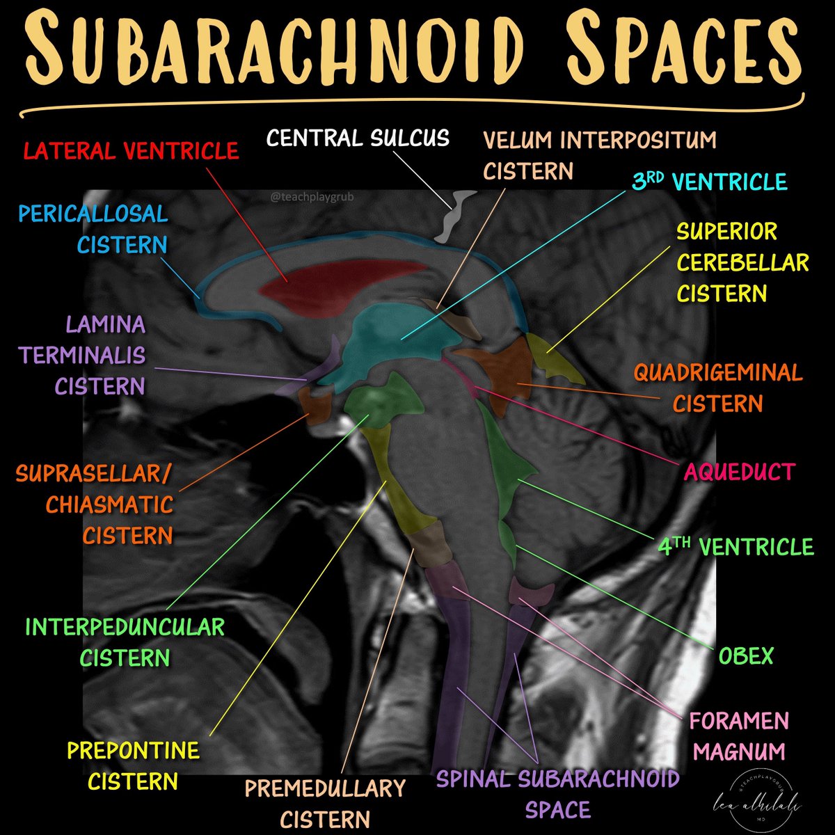Sink or swim!

Brain is swimming in CSF!

CSF is key for protection, buoyancy, &amp; hormone/waste transport

Most know basic ventricular anatomy well, but not subarachnoid anatomy.

How many cisterns do YOU know?

Here’s a quick guide to the key midline cisterns &amp; what to know for
