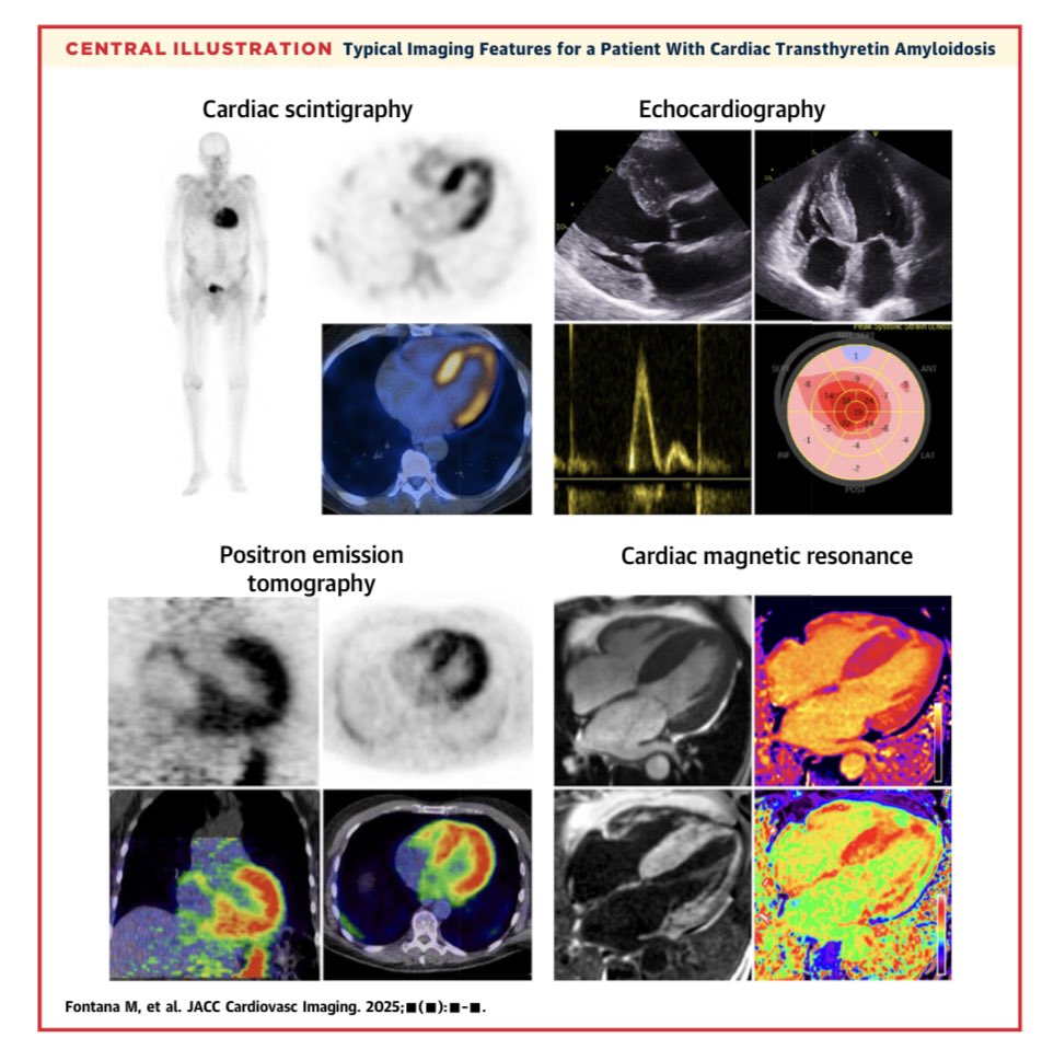 Edgardo Alania (@ed_alania) on Twitter photo 🔴 The Last Decade in Cardiac Amyloidosis: Advances in Understanding Pathophysiology, Diagnosis & Quantification, Prognosis, Treatment Strategies & Monitoring Response <a href="/JACCJournals/">JACC Journals</a> #Cardiology #cardioEd #cardiotwitter #Amyloidosis 🔴 The Last Decade in Cardiac Amyloidosis: Advances in Understanding Pathophysiology, Diagnosis & Quantification, Prognosis, Treatment Strategies & Monitoring Response <a href="/JACCJournals/">JACC Journals</a> #Cardiology #cardioEd #cardiotwitter #Amyloidosis
