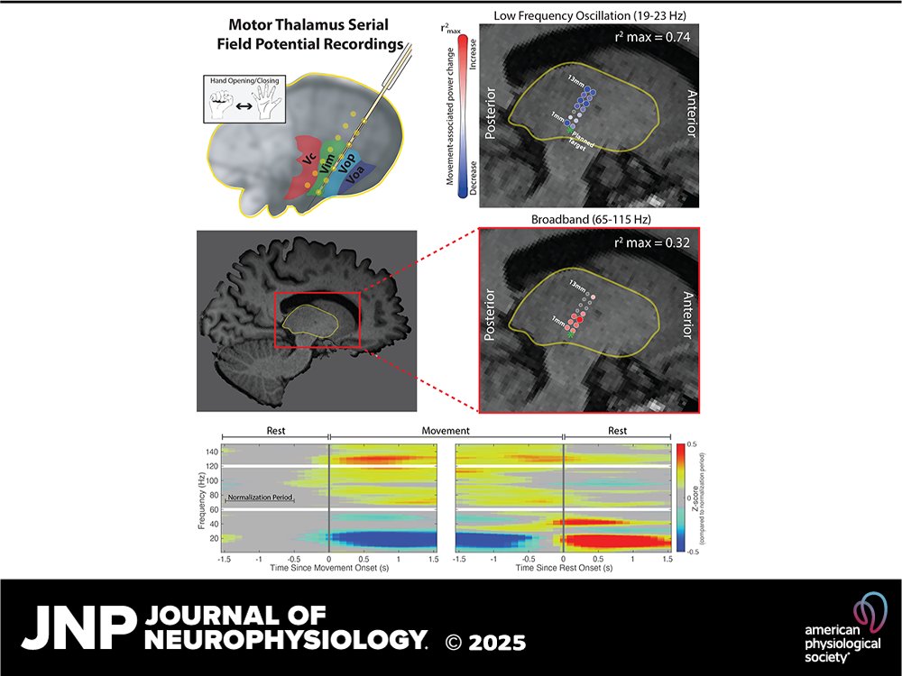 MatthewBaker_'s tweet photo. We find movement-associated changes in broadband power in the motor thalamus in DBS intraop recordings. Similar to motor cortex, these changes are more focal in the motor thalamus compared to low-frequency oscillations. https://t.co/NVTrjPzRvA