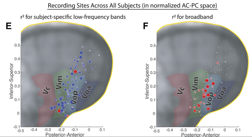 MatthewBaker_'s tweet photo. We find movement-associated changes in broadband power in the motor thalamus in DBS intraop recordings. Similar to motor cortex, these changes are more focal in the motor thalamus compared to low-frequency oscillations. https://t.co/NVTrjPzRvA