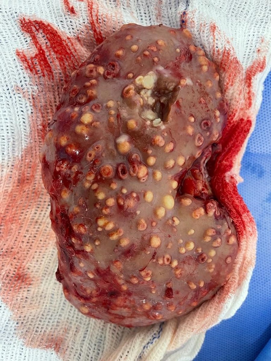 Kidney_Int's tweet photo. Transmission of #tuberculosis via #kidneyallograft

Renal allograft-transmitted tuberculosis is a rare and potentially fatal infection in the early post-transplant period.

https://t.co/gz1DqAba1c

#KINephrologyImage #KidneyTransplantation https://t.co/AT2amWHIoh