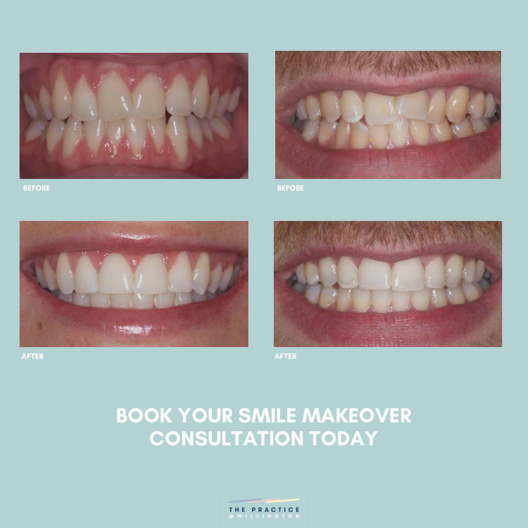 ThePracticeWil1's tweet photo. Feel confident when you smile. Start by asking us what your options are …!
☎️ 01283 707385
📧 hello@thepracticewillington.co.uk
🌍 https://t.co/VgvDUeUii3

#awardwinningteam #newyearnewme #smile #digitaldentist #dentist #makeover #willington #whiteteeth #derby #derbyshire https://t.co/fzkqsIL8Vi