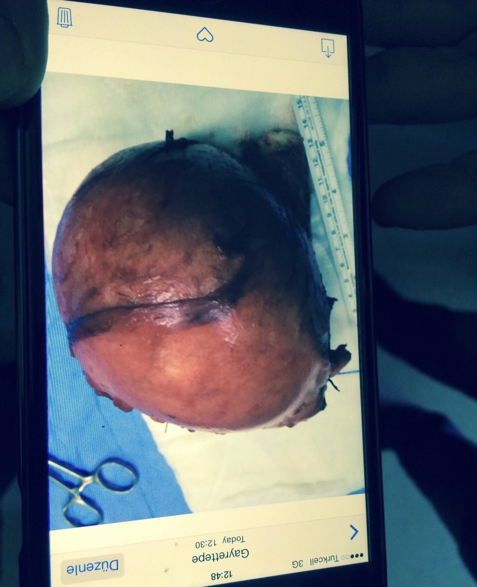 35 yıldır bu işi yapıyorum , 24 yılım cehennem , anlatsam anlamadılar , sustum hasta ettiler . Bana dönüşü şahane bir tümör oldu sonunda . Bu yıl şubat 21 de tam 10. Yılım bitiyor , 38 dikiş bir o kadar acı ve herkesten saklayarak geçen yıllar ! Ya siz çok kötüsünüz yada ben ben