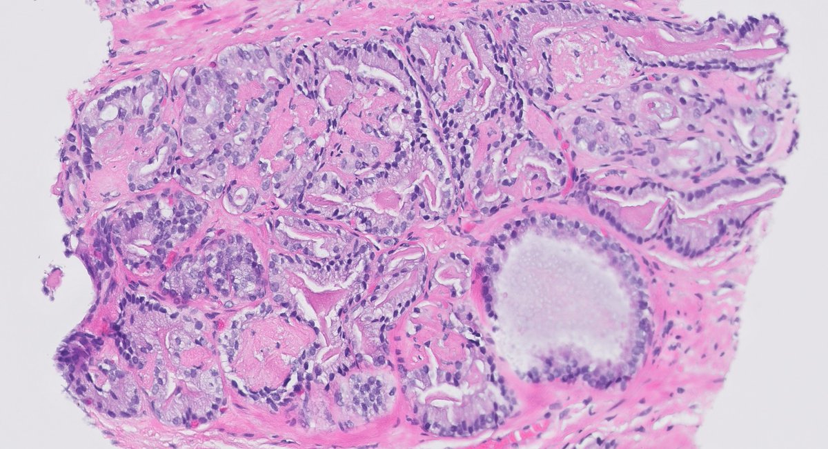 slusagar's tweet photo. #grayzonepath #GUpath prostate bx:

when there's extensive mucinous fibroplasia, definitive grading can be challenging! (rule is to "subtract off the mucinous fibroplasia &amp; grade the underlying architecture)

DDx here seems 3+3 vs 3+4 [some (not me😅) could argue 4+3 as well] https://t.co/bFgV752Pca