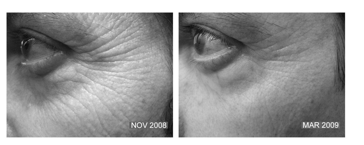 AlpacaAurelius's tweet photo. Putting green tea on your skin then using a red light (or going in the sun) is one of the most anti aging skin hacks.

In just a few months, it was able to rejuvenate the skin and reduce wrinkles in these patients. https://t.co/hJb3kxsDqm