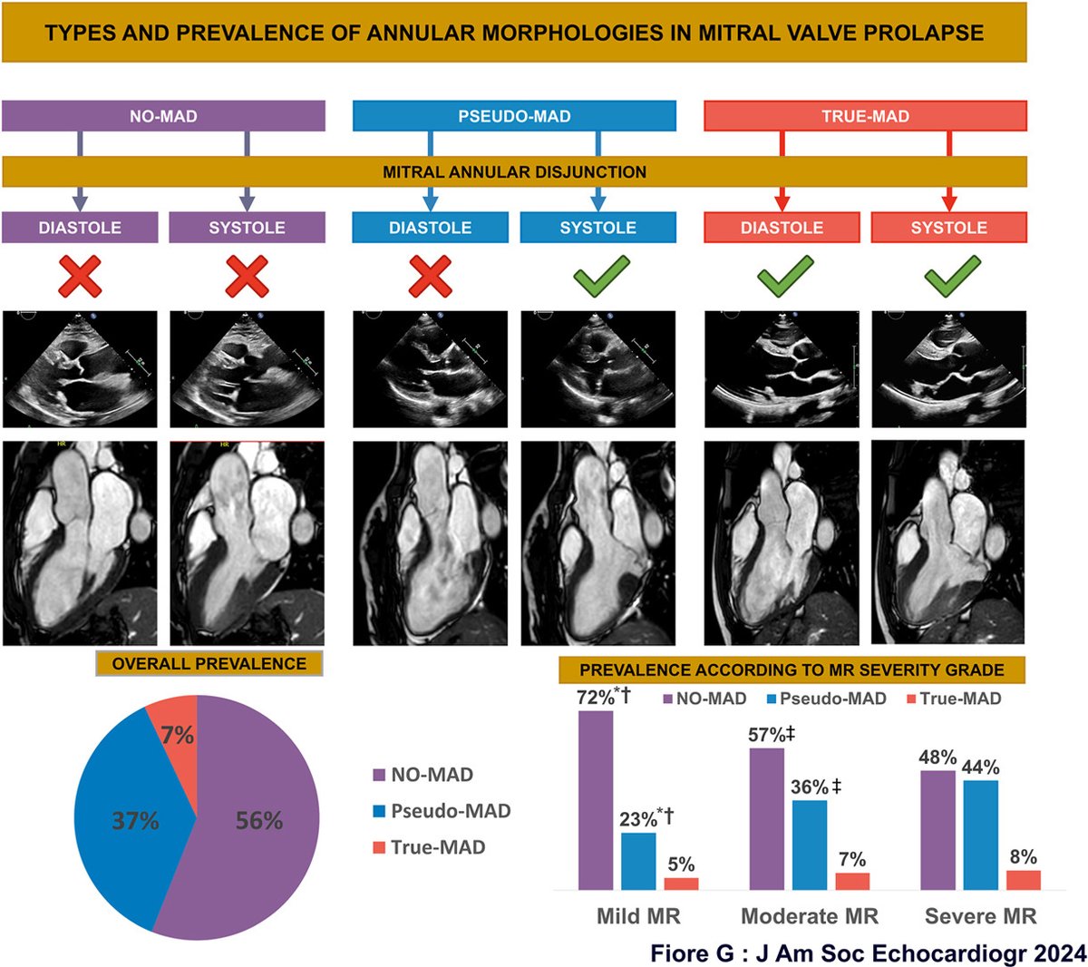 Mitral annular disjunction (MAD) is commonly evaluated at end systole.

However, a systolic-only disjunction is merely apparent, and 2 distinct phenotypes have been identified: True-MAD and Pseudo-MAD. bit.ly/4jsK9an <a href="/JournalASEcho/">JASE</a>