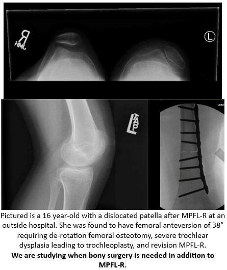 Please see the case below, courtesy of Dr. <a href="/MatthewBollier/">Matthew Bollier</a>, Professor of Orthopaedic Surgery at the University of Iowa and JUPITER PI.