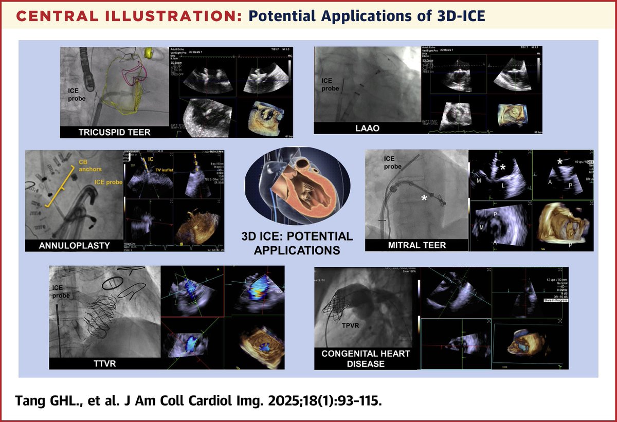JACC Journals (@jaccjournals) on Twitter photo #JACCIMG multidisciplinary position statement: 3D-ICE is becoming a valuable complement & potential alternative to #echofirst TEE for structural heart intervention guidance. Learn more about indications and standardized use. jacc.org/doi/10.1016/j.ā¦
#cvImaging <a href="/azeemlatib/">Azeem Latib</a> #JACCIMG multidisciplinary position statement: 3D-ICE is becoming a valuable complement & potential alternative to #echofirst TEE for structural heart intervention guidance. Learn more about indications and standardized use. jacc.org/doi/10.1016/j.ā¦
#cvImaging <a href="/azeemlatib/">Azeem Latib</a>
