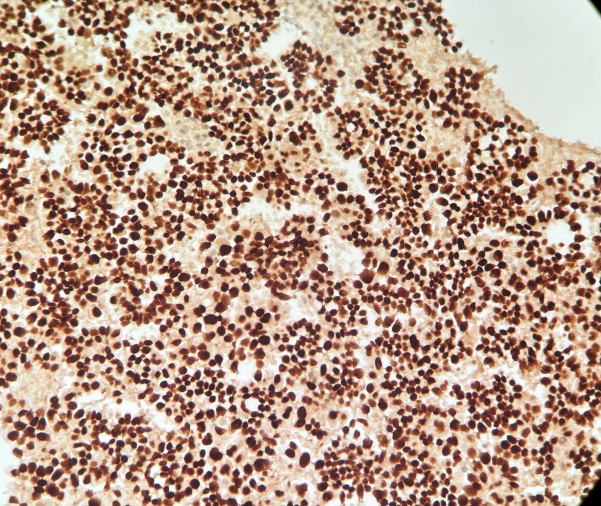 #cytorocks #cytoweek pleural effusion ,75 year old female ,first time diagnosis by fluid cytology
Thin prep slide,cell block(low/high) TTF-1 
Metastatic lung adenocarcinoma,can it be anything else ? #pathtwitter