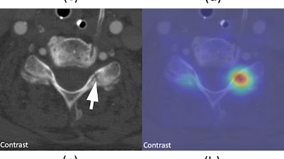 Radiology: Artificial Intelligence (@radiology_ai) on Twitter photo Evaluating performance of top #AI models from the <a href="/RSNA/">RSNA</a> 2022 Cervical Spine Fracture challenge doi.org/10.1148/ryai.2… <a href="/FelipeKitamura/">Felipe Kitamura</a> <a href="/UofTMedIm/">UofT Medical Imaging</a> <a href="/DrErvinSejdic/">Dr. Ervin Sejdić</a> #DeepLearning #competition #ML Evaluating performance of top #AI models from the <a href="/RSNA/">RSNA</a> 2022 Cervical Spine Fracture challenge doi.org/10.1148/ryai.2… <a href="/FelipeKitamura/">Felipe Kitamura</a> <a href="/UofTMedIm/">UofT Medical Imaging</a> <a href="/DrErvinSejdic/">Dr. Ervin Sejdić</a> #DeepLearning #competition #ML