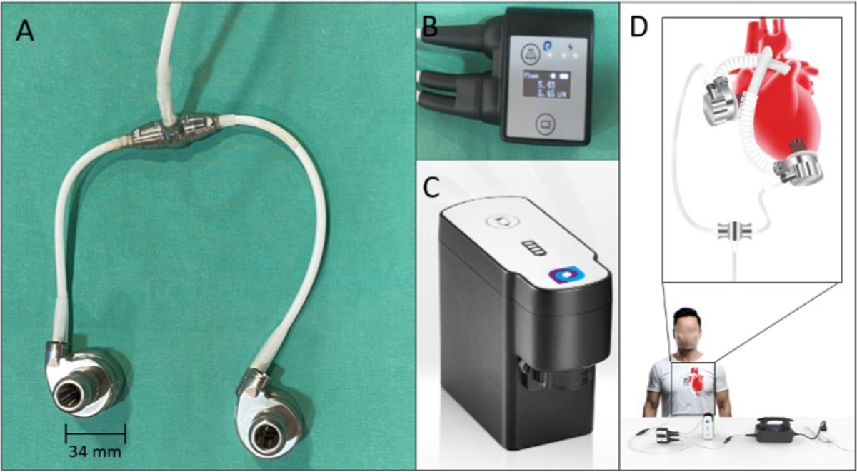 ArtifOrgans's tweet image. Two Coupled #ContinuousFlow #VADs as a Novel #BIVAD With One Driveline—Acute #AnimalStudy Results
👉tinyurl.com/d4vy6sys
@MHH_life🇩🇪| @JanSchmitto #BiventricularSupport
