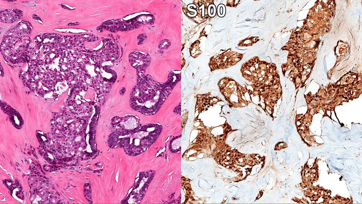 Case of Secretory Carcinoma of Breast🔬

Secretory carcinoma is an exceptionally rare triple-negative breast tumor analogous to its salivary gland counterpart, shows abundant eosinophilic or amphophilic secretions, and typically positive for S100.

#PathX #PathTwitter #breastpath
