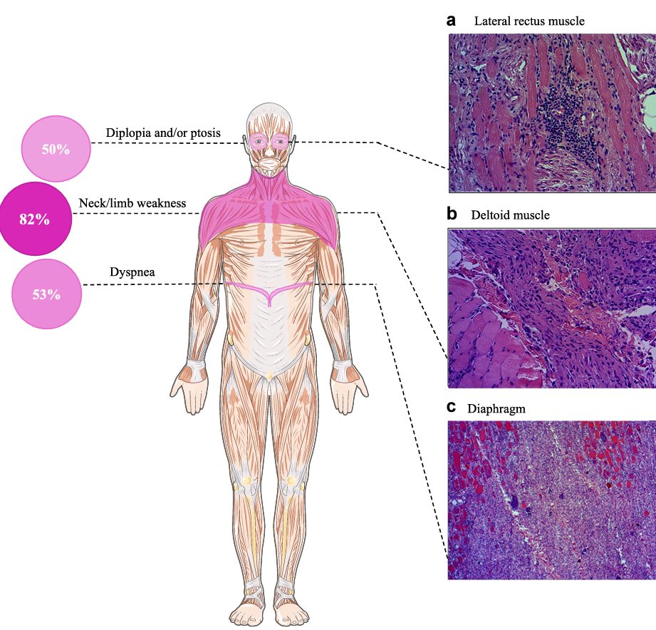 DrJE-Salem (@drjesalem) on Twitter photo Today <a href="/LancetRH_Europe/">The Lancet Reg Health-Europe</a>, immune checkpoint inhibitor "myasthenia gravis syndrome" is overwhelmingly a myositis with peculiar pseudobulbar clinical features => Major impact on how to treat ! <a href="/CardioOncology/">Javid Moslehi</a> <a href="/jelevenson/">Joshua Levenson, MD</a> <a href="/salimhayek/">Salim S. Hayek, MD</a> <a href="/LorenzLehmann/">Lorenz Lehmann</a>
<a href="/DrJNaidoo/">Jarushka Naidoo</a> sciencedirect.com/science/articl… Today <a href="/LancetRH_Europe/">The Lancet Reg Health-Europe</a>, immune checkpoint inhibitor "myasthenia gravis syndrome" is overwhelmingly a myositis with peculiar pseudobulbar clinical features => Major impact on how to treat ! <a href="/CardioOncology/">Javid Moslehi</a> <a href="/jelevenson/">Joshua Levenson, MD</a> <a href="/salimhayek/">Salim S. Hayek, MD</a> <a href="/LorenzLehmann/">Lorenz Lehmann</a>
<a href="/DrJNaidoo/">Jarushka Naidoo</a> sciencedirect.com/science/articl…
