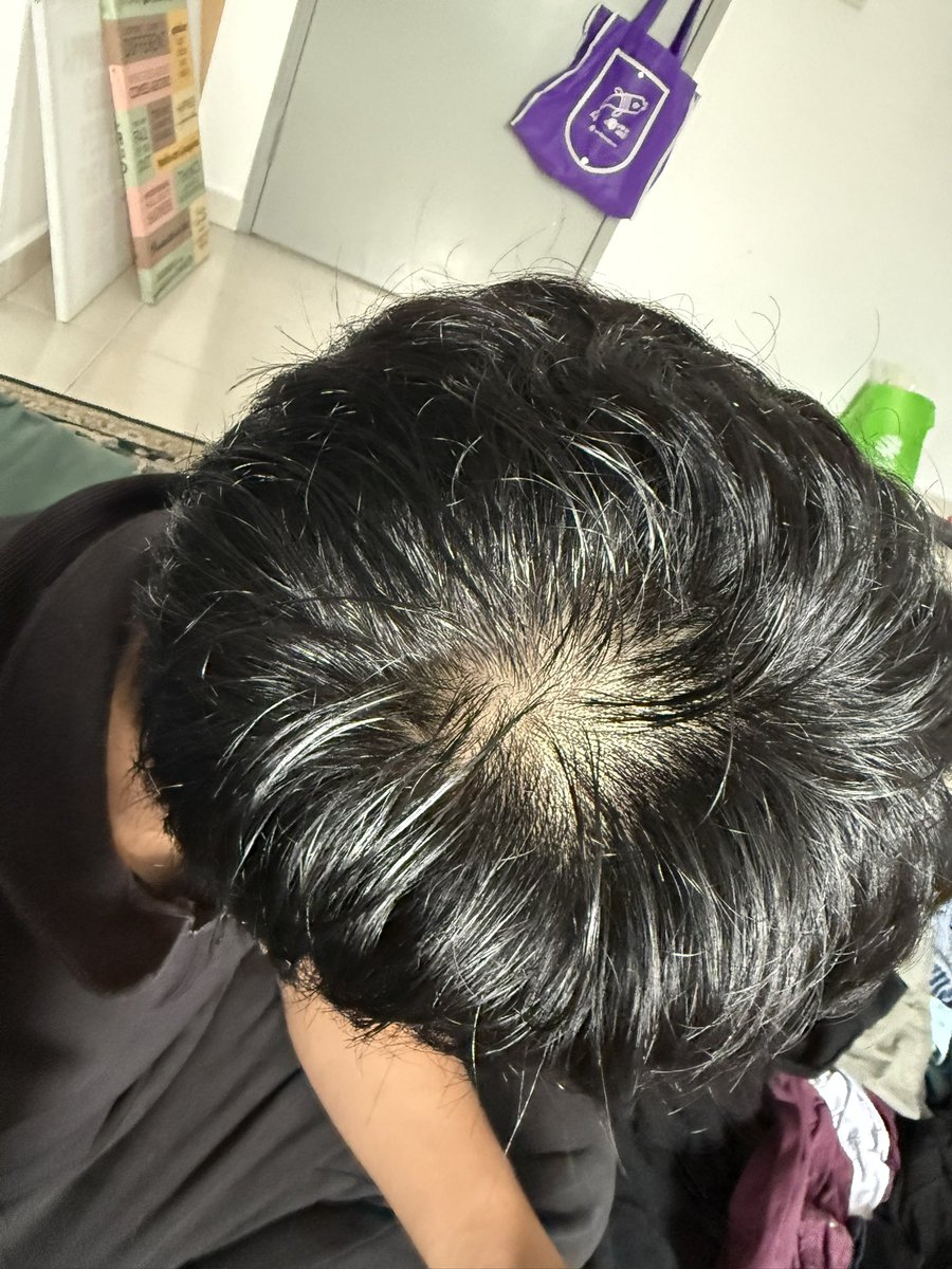 korang any tips . rambut aku dah start botak 🥹