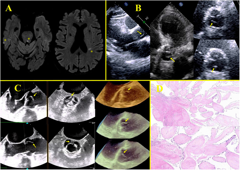 REC Publications (@revespcardiol) on Twitter photo Fibroelastoma papilar aórtico e ictus: un caso ilustrativo #reccardioclinics <a href="/franbuendia97/">Francisco Buendia Santiago</a> <a href="/Doctorabellan/">José Abellán</a> reccardioclinics.org//es-fibroelast… Fibroelastoma papilar aórtico e ictus: un caso ilustrativo #reccardioclinics <a href="/franbuendia97/">Francisco Buendia Santiago</a> <a href="/Doctorabellan/">José Abellán</a> reccardioclinics.org//es-fibroelast…