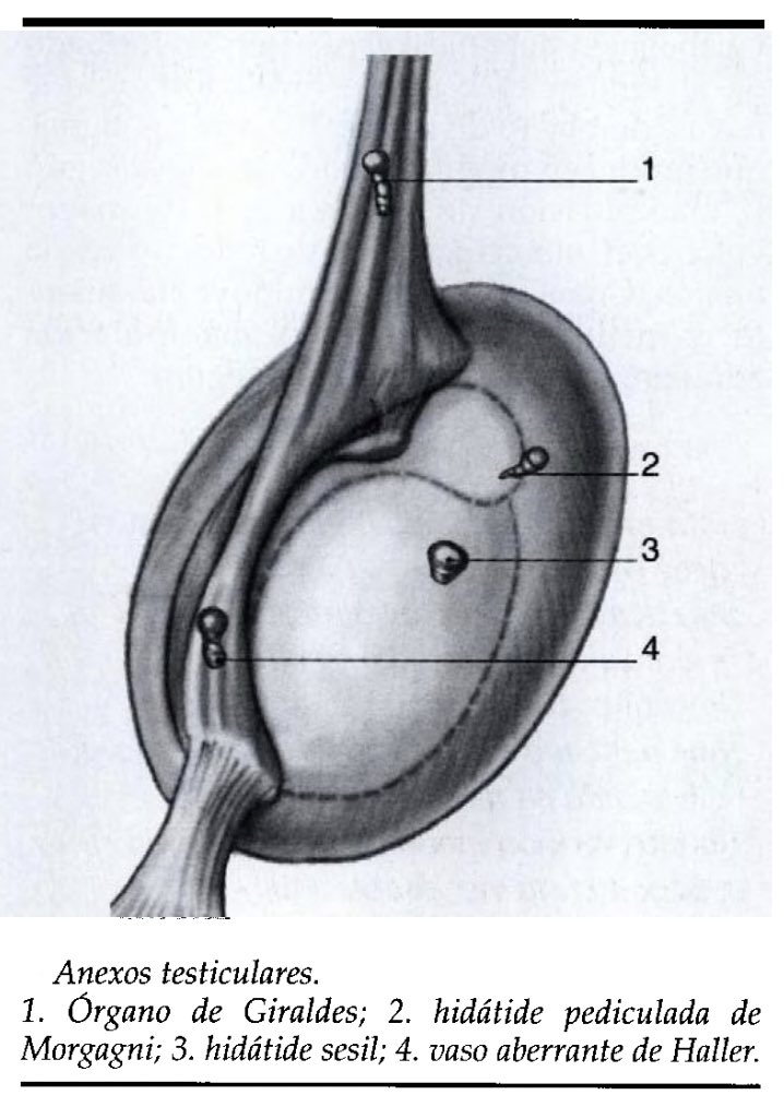 SocUroPedMx's tweet image. Para recordar: 🤓🧠

📝Los ANEXOS TESTICULARES son vestigios embrionarios desprovistos de función que forman un apéndice en el polo anterior del testículo o en la cabeza del epidídimo, en el interior de la vaginal.

🧵(1/2)… #SoMe4PedSurg #UroSoMe #Urology #morgagni