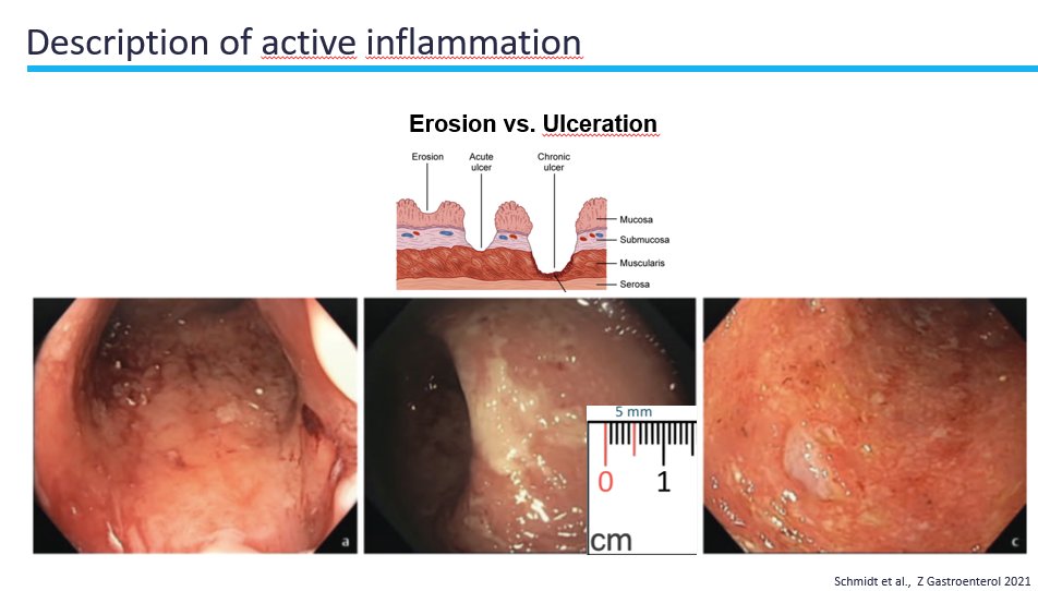 Joseph Sleiman, MD, FACP (@josephhabibi_md) on Twitter photo <a href="/JPAchkarMD/">Jean-Paul Achkar</a> 3/ Tips for describing active inflammation
<a href="/IBD_FloMD/">Florian Rieder</a> <a href="/VictorChedidMD/">Victor Chedid, MD</a> <a href="/Cindytraboulsi/">Cindy Traboulsi</a> <a href="/KatieFalloonMD/">Katie Falloon</a> <a href="/SiriUrquhartMD/">Siri Urquhart, M.D.</a> <a href="/JuneTomeMD/">June Tome</a> <a href="/DarrellPardi/">Darrell Pardi</a> <a href="/Badr_AlBawardy/">Badr Al-Bawardy</a> <a href="/OmarMTag/">Omar Tageldin (Tag), MD</a> <a href="/AnikaParad/">Anika Paradkar M.D.</a> <a href="/GKochharMD/">Gursimran Kochhar MD</a> <a href="/MLongMD/">Millie Long</a> <a href="/jalpa_devi/">Jalpa Devi</a> <a href="/JPAchkarMD/">Jean-Paul Achkar</a> 3/ Tips for describing active inflammation
<a href="/IBD_FloMD/">Florian Rieder</a> <a href="/VictorChedidMD/">Victor Chedid, MD</a> <a href="/Cindytraboulsi/">Cindy Traboulsi</a> <a href="/KatieFalloonMD/">Katie Falloon</a> <a href="/SiriUrquhartMD/">Siri Urquhart, M.D.</a> <a href="/JuneTomeMD/">June Tome</a> <a href="/DarrellPardi/">Darrell Pardi</a> <a href="/Badr_AlBawardy/">Badr Al-Bawardy</a> <a href="/OmarMTag/">Omar Tageldin (Tag), MD</a> <a href="/AnikaParad/">Anika Paradkar M.D.</a> <a href="/GKochharMD/">Gursimran Kochhar MD</a> <a href="/MLongMD/">Millie Long</a> <a href="/jalpa_devi/">Jalpa Devi</a>