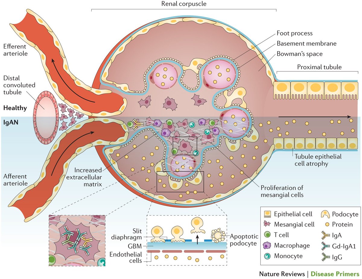 edgarvlermamd's tweet photo. Pathogenesis of IgA Nephropathy from @sydney_tang 
#Nephpearls #KDIGOGEMS 💎

👉 https://t.co/UADFqpsWs7
👉 https://t.co/FMjabLtTjk https://t.co/8m24YNE60D