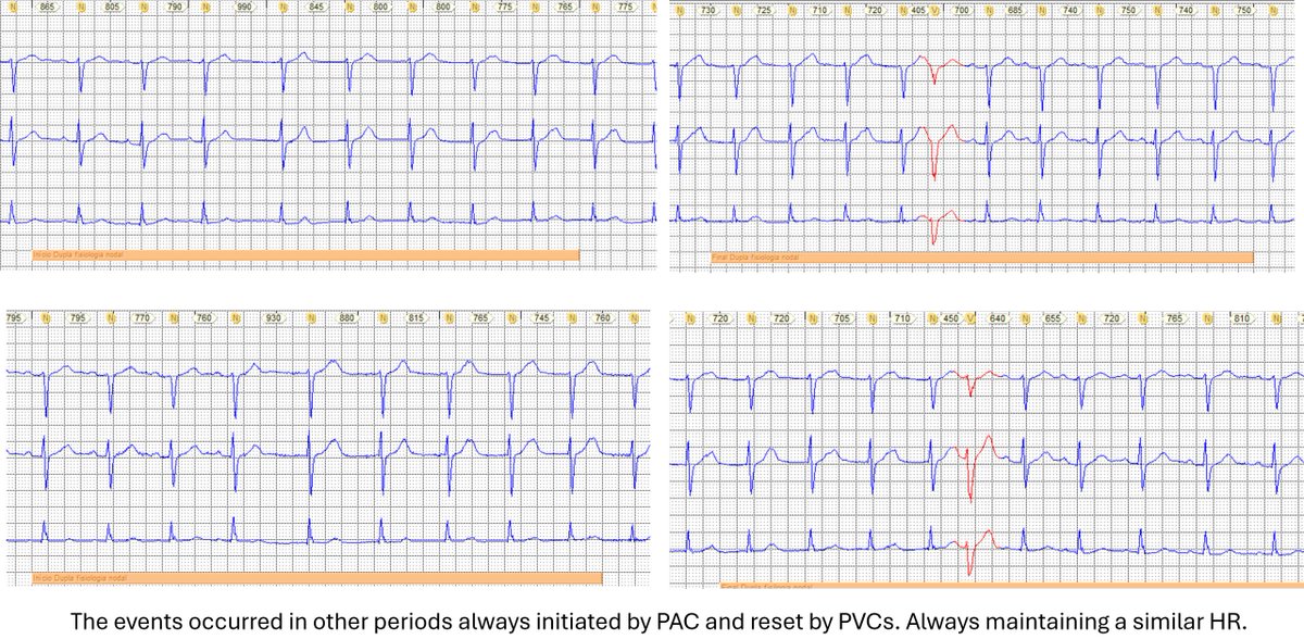 Antonio Thomaz de Andrade, MD 🇧🇷 (@athomazandrade) on Twitter photo <a href="/syamkumarmd/">Syamkumar</a> Another point: The HR of the sinus rhythm is the same before and after the apparent non-conducted PAC. These events happened frequently. If it were a junctional rhythm with HR similar to the sinus I would expect that at some point we would meet with a more obvious AV dissociation <a href="/syamkumarmd/">Syamkumar</a> Another point: The HR of the sinus rhythm is the same before and after the apparent non-conducted PAC. These events happened frequently. If it were a junctional rhythm with HR similar to the sinus I would expect that at some point we would meet with a more obvious AV dissociation