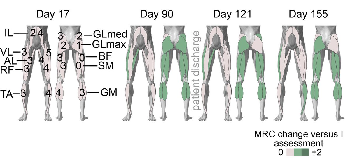 Science Translational Medicine (@sciencetm) on Twitter photo Harnessing both low- and high-frequency epidural electrical stimulation, researchers devise personalized protocols that foster rehabilitation and walking recovery in two #SpinalCordInjury patients while reducing spasticity. <a href="/_smicera/">Silvestro Micera</a> <a href="/MINE_Neurotech/">MINE Neurotechnology Lab</a> scim.ag/4gO3UHs Harnessing both low- and high-frequency epidural electrical stimulation, researchers devise personalized protocols that foster rehabilitation and walking recovery in two #SpinalCordInjury patients while reducing spasticity. <a href="/_smicera/">Silvestro Micera</a> <a href="/MINE_Neurotech/">MINE Neurotechnology Lab</a> scim.ag/4gO3UHs