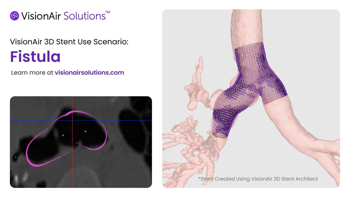 This #FistulaFriday, we're emphasizing the importance of 3D stents and tailoring them to your patients. Each complex airway is unique and deserves a stent designed to fit their individual needs for the best possible outcomes!

#Stenting #Airway #Fistula #3DStents