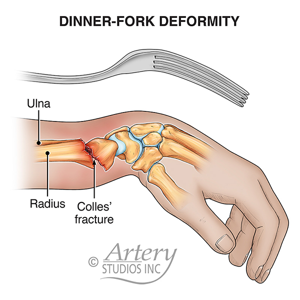 Medical Monikers: Dinner-fork Deformity

Typically caused by a fall onto an outstretched hand (FOOSH), a Colles' fracture of the radius creates a distinctive bend of the wrist, known as the dinner-fork deformity.