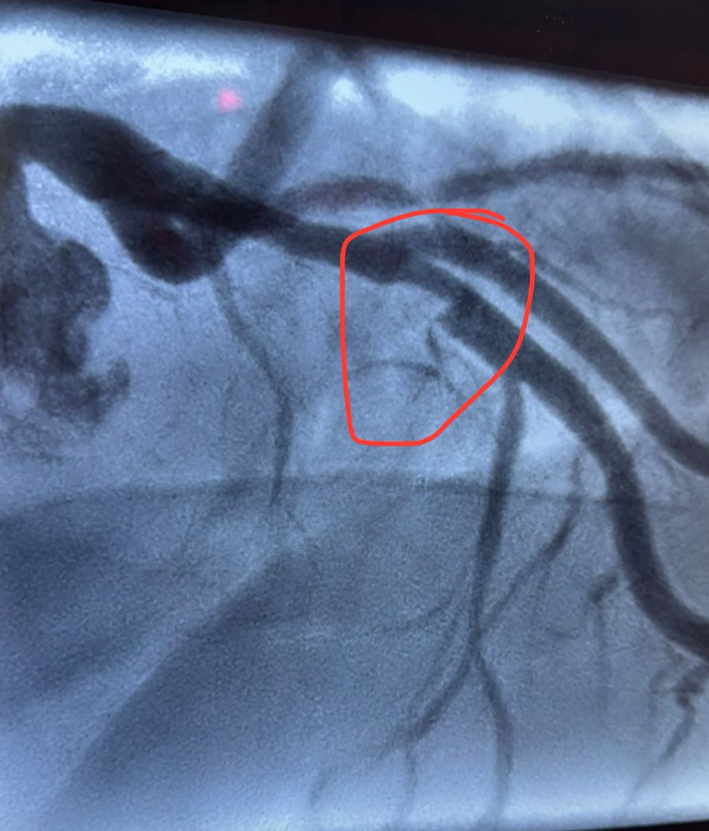 PedroCerize's tweet image. Vamos falar de coisas imprevisíveis:

Depois de terminar o Ironman eu estava demorando mais que o normal pra me recuperar. Nesse período um amigo meu, que ganhou o Ironman Brasil em 2023 no amador teve um AVC. Outro triatleta tinha morrido de infarto em setembro 

Fui fazer o…