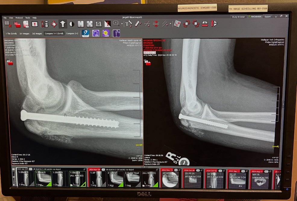 I had a minor setback in the fall. Surgery to repair the growth plate in my throwing arm was a success. Working hard to get back for junior year of high school baseball. Thanks to <a href="/performstrongpt/">Alex Gett</a> for pushing me hard.