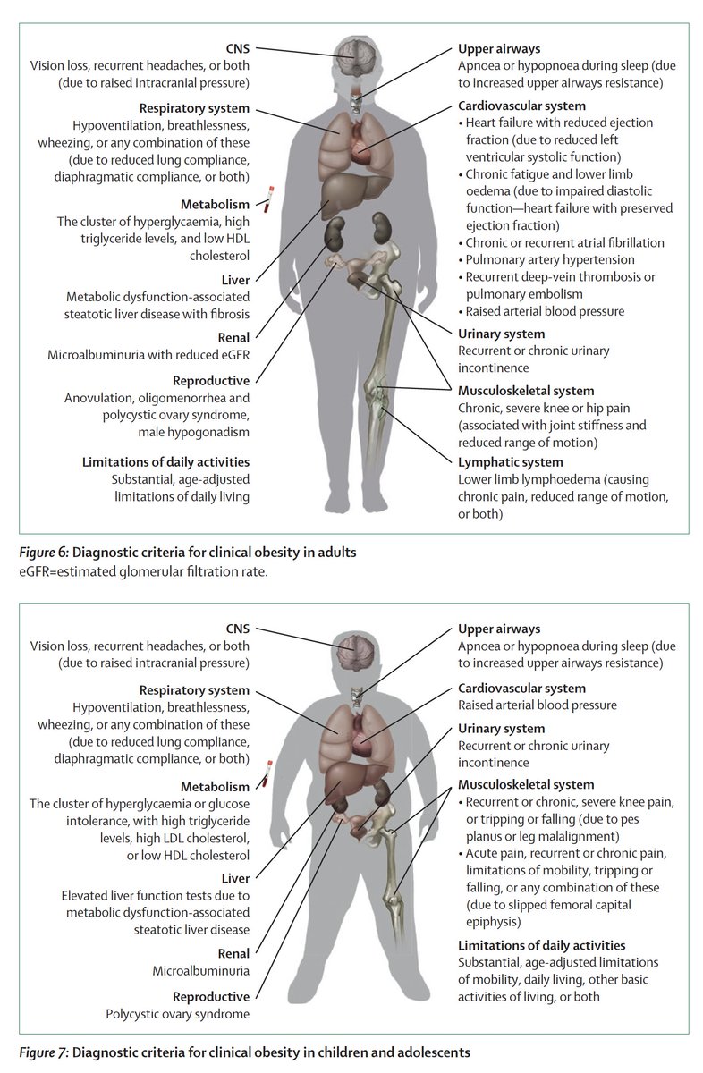 Eric Topol (@erictopol) on Twitter photo This has been needed for a long time!
Redefining obesity
A new report of <a href="/TheLancetEndo/">The Lancet Diabetes & Endocrinology</a> commission that overrides current BMI categories and better defines features and pathophysiologic consequences of pre-clinical and clinical obesity
thelancet.com/journals/landi… open-access
(such as This has been needed for a long time!
Redefining obesity
A new report of <a href="/TheLancetEndo/">The Lancet Diabetes & Endocrinology</a> commission that overrides current BMI categories and better defines features and pathophysiologic consequences of pre-clinical and clinical obesity
thelancet.com/journals/landi… open-access
(such as