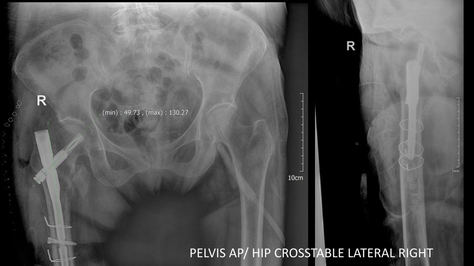 micosaturn's tweet photo. Curious if anyone had an experience with an incarcerated screw (dont know i used the correct term)
Had to burr the hole to take out the screw
#orthotwitter
#orif
#trauma https://t.co/1CH0DOSZN7
