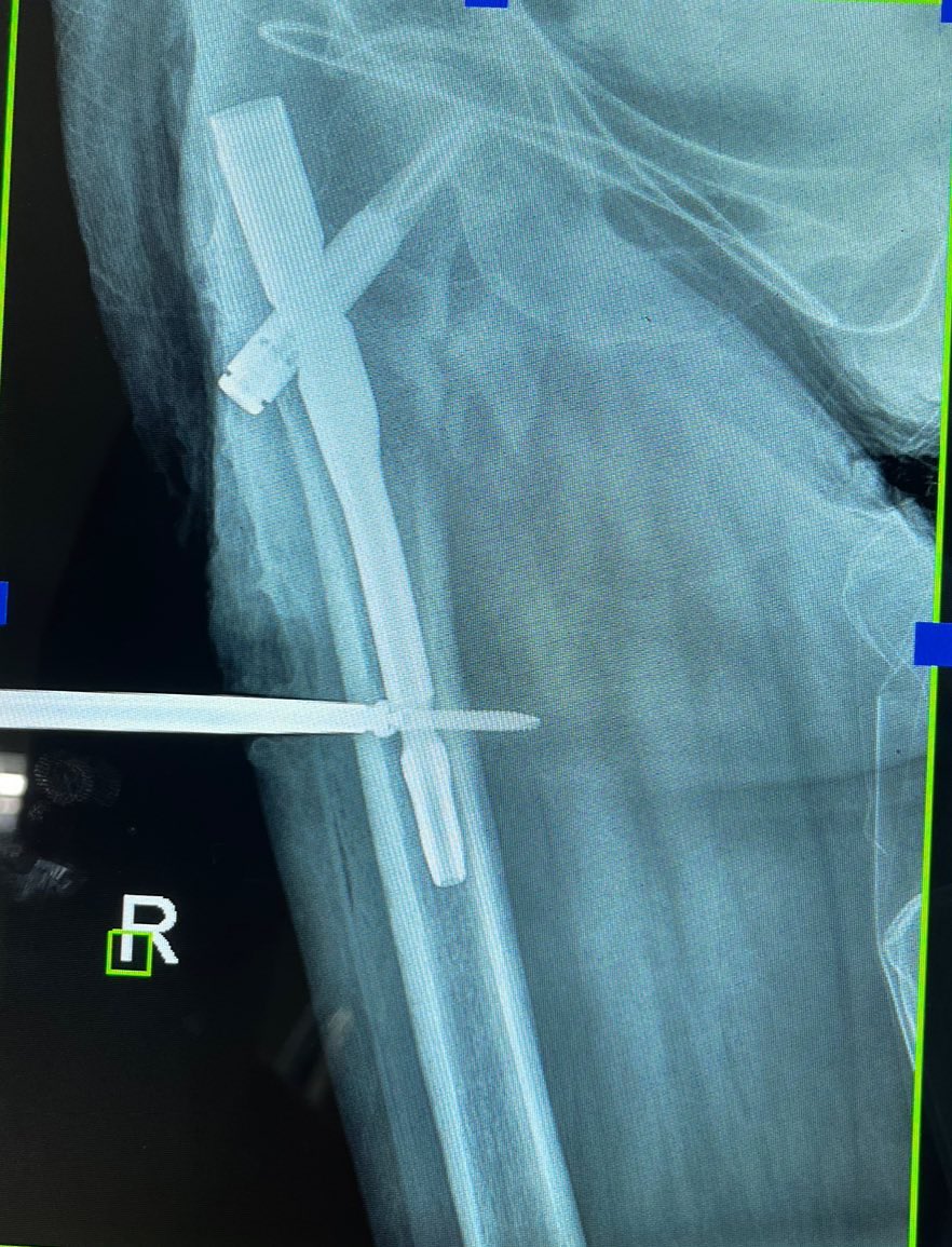 micosaturn's tweet photo. Curious if anyone had an experience with an incarcerated screw (dont know i used the correct term)
Had to burr the hole to take out the screw
#orthotwitter
#orif
#trauma https://t.co/1CH0DOSZN7