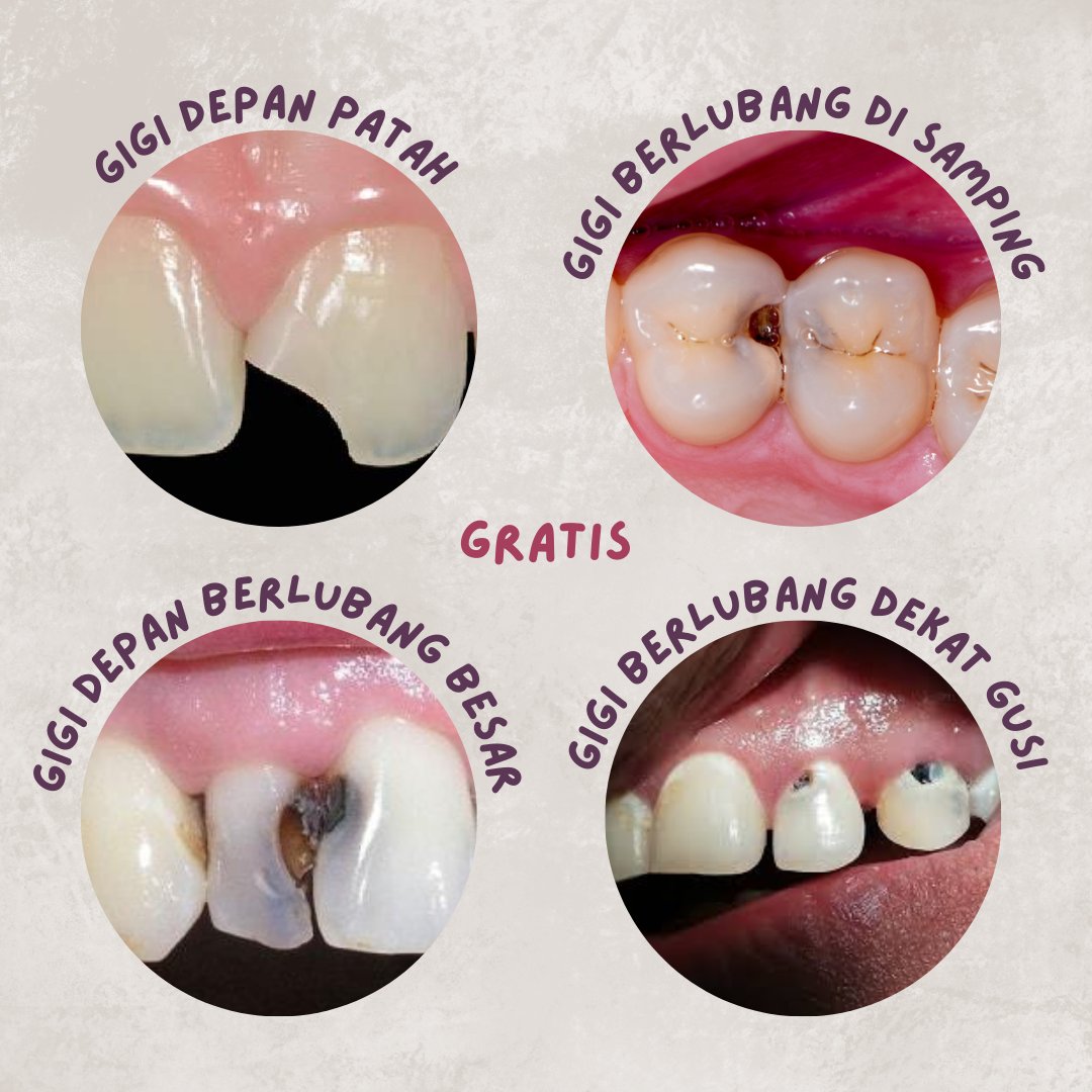 sylzzlehams's tweet photo. halo, kami koas gigi di bandung👋🏻 kalau kamu/kerabat memiliki keluhan gigi seperti di gambar dan membutuhkan perawatan seperti cabut, tambal, perawatan saluran akar, gigi tiruan, scaling, dan lainnya boleh dm yaa!!

perawatan dalam pengawasan drg spesialis dan gratis. thank you💖 https://t.co/uqCLyv7cnd