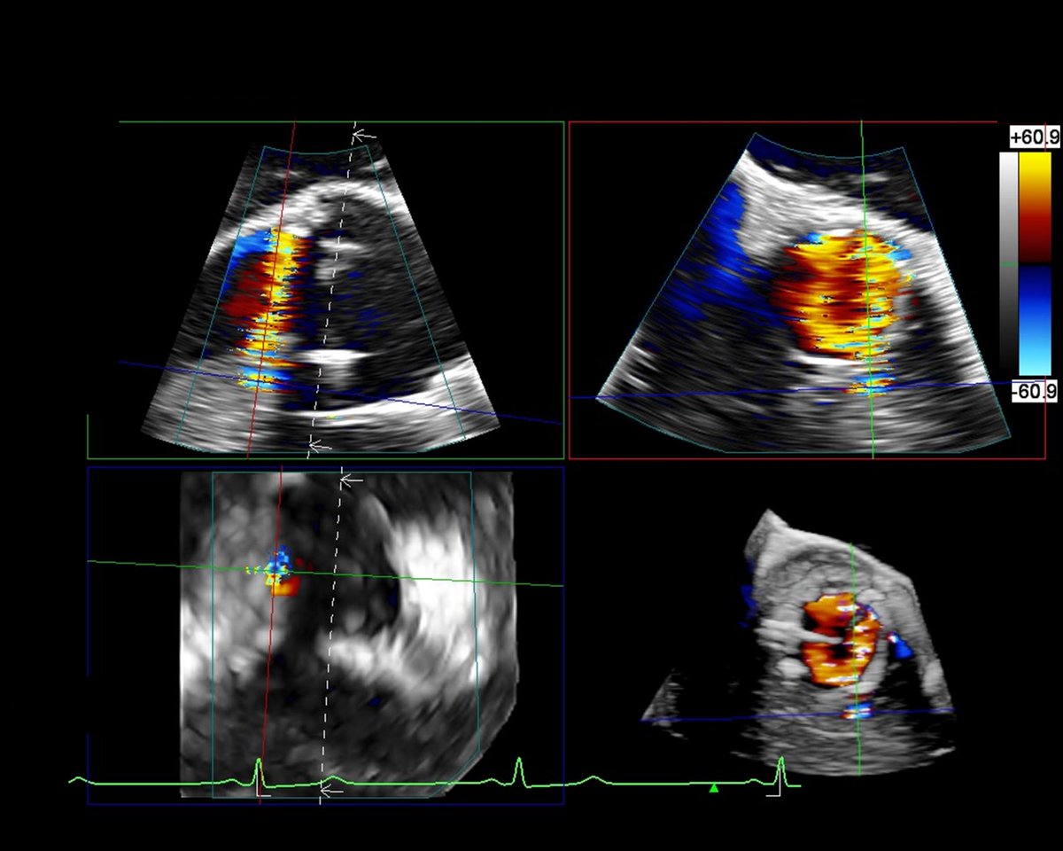 Twinkle xu (@twinkle_imr) on Twitter photo Paper from <a href="/TomKMWang/">Tom Wang MBChB MD</a>'s team (Cleveland Clinic, <a href="/CleClinicMD/">Cleveland Clinic MD</a>), titled "Contemporary Multi-modality Imaging of Prosthetic Aortic Valves".
Discover how echocardiography, #CT, #MRI, and nuclear #imaging play a key role in diagnosing #valve pathologies.
🔗: imrpress.com/journal/RCM/26… Paper from <a href="/TomKMWang/">Tom Wang MBChB MD</a>'s team (Cleveland Clinic, <a href="/CleClinicMD/">Cleveland Clinic MD</a>), titled "Contemporary Multi-modality Imaging of Prosthetic Aortic Valves".
Discover how echocardiography, #CT, #MRI, and nuclear #imaging play a key role in diagnosing #valve pathologies.
🔗: imrpress.com/journal/RCM/26…