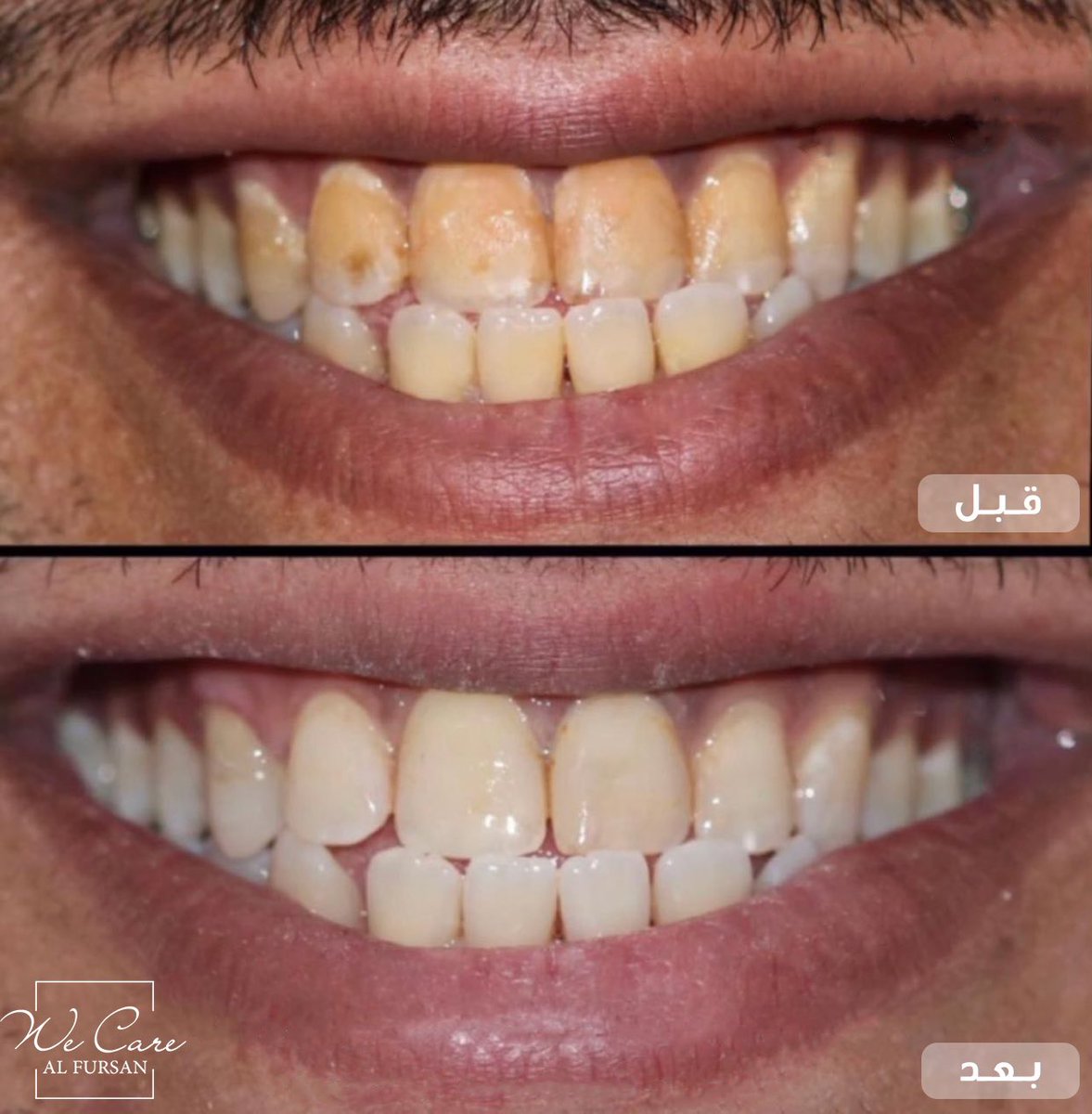 ازالة التصبغات مع اعادة ترميم حشوات الأسنان الأمامية .. 
ابتسامتك ممكن تكون اجمل بلمسات بسيطة 

للاستفسارات والمواعيد:
0535019888
#مركز_الفرسان_الطبي
الرياض - حي الملك سلمان