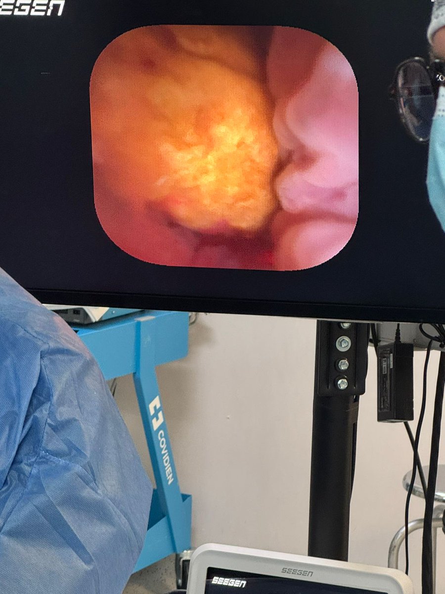 Helen_Wanghelen's tweet image. 🙌 ¡Un procedimiento exitoso con el ureteroscopio desechable #UROFINO en el #HospitalHidalgo, #Aguascalientes, #México!
Estamos emocionados de compartir el éxito de un procedimiento innovador utilizando el avanzado ureteroscopio desechable UROFINO.