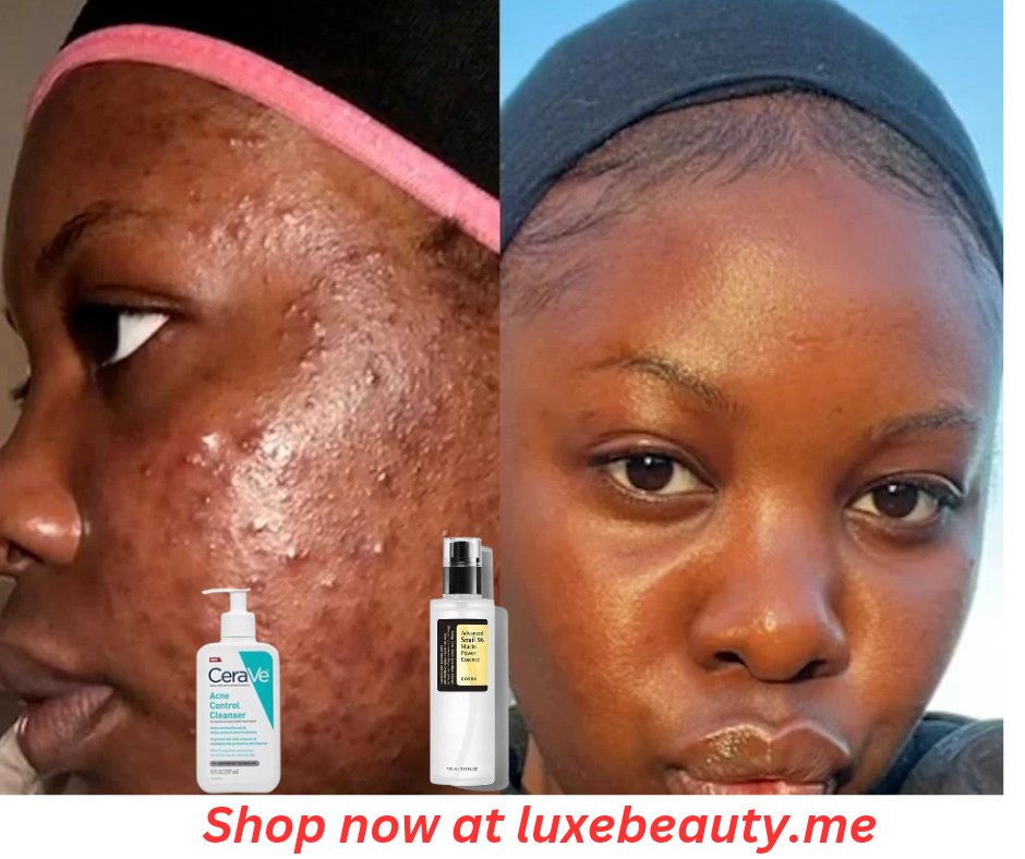 luxe_beuty's tweet image. WIN BACK YOUR SKIN!
 Get your Acne Control Combo for just UGX150,000! Clear, radiant skin is just a step away! Call/WhatsApp 0789401436 to order! #AcneControl #SkinCare #GlowUp